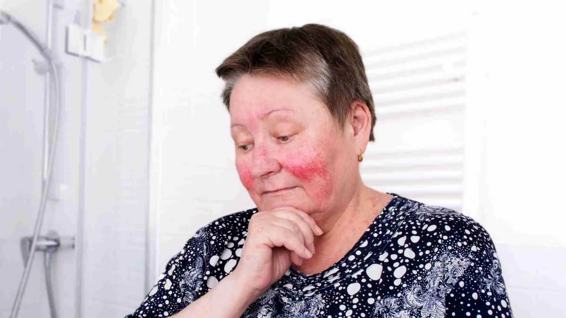 4 Tips For Soothing Rosacea From A Compounding Pharmacy